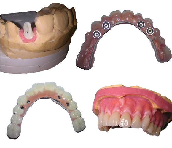 Fiksna i mobilna protetika